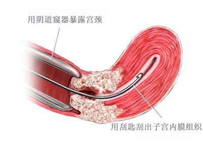 S形宫腔吸引管