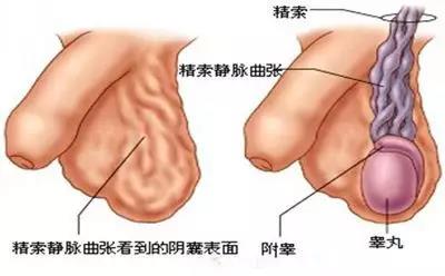 精索静脉曲张