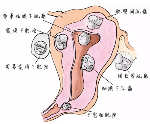 子宫肌瘤会导致不孕吗?